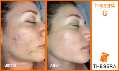 Thesera G Treatment