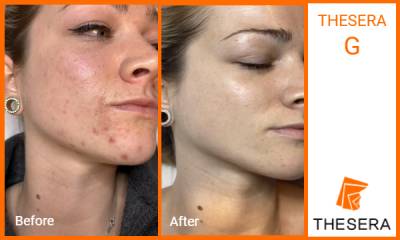 Thesera G Treatment