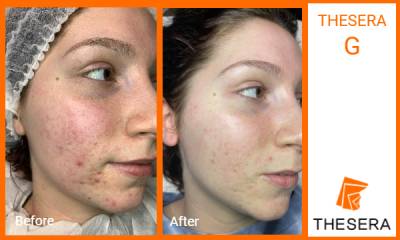 Thesera G Treatment