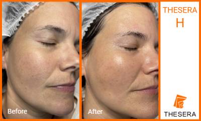 Thesera H Treatment