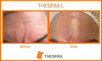 Thesera L Treatment