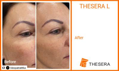 Thesera L Treatment