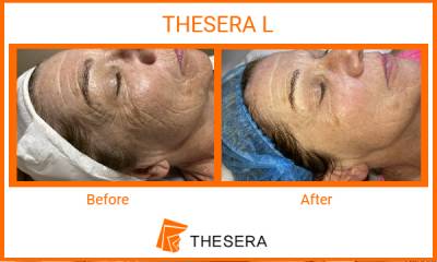 Thesera L Treatment