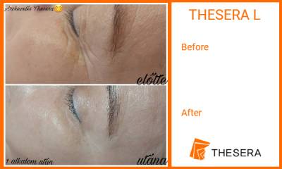 Thesera L Treatment